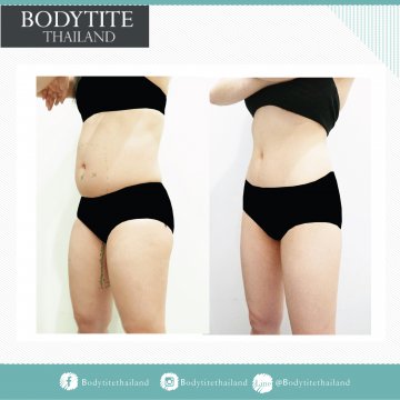 Abdomen Liposuction