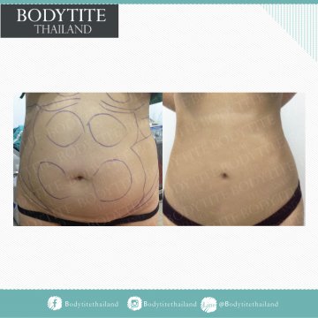 Abdomen Liposuction