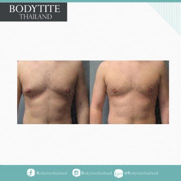 Male Breast Liposuction