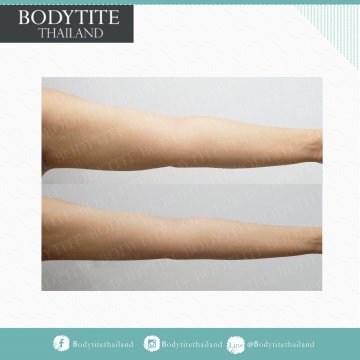 Arm Liposuction