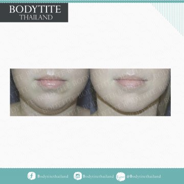 Facial Liposuction