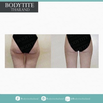 Hip Liposuction